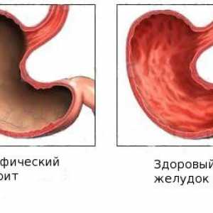 Fáze léčby u chronické atrofické gastritidy