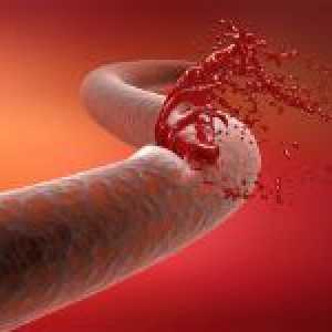 Jak rychle zastavit krvácení z rány