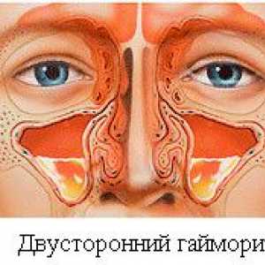 Jak a čím správně léčit zánět vedlejších nosních dutin?