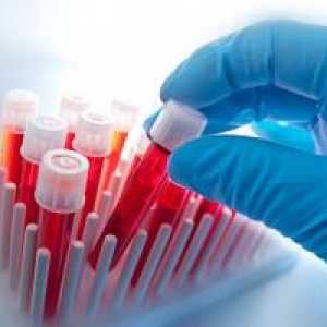 Jak a proč bych měl darovat krevní test pro toxoplazmózu