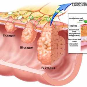 Jak vyléčit žaludeční adenokarcinom?