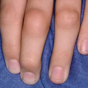 Jak se k léčbě oteklých kloubů prstů