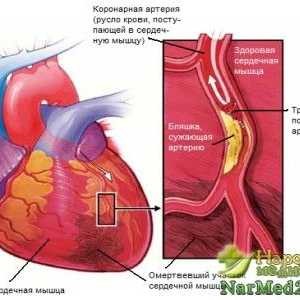 Jak k léčbě anginy srdce za použití tradičních metod