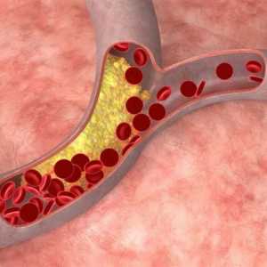 Jak snížit hladinu cholesterolu doma?
