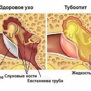 Jaké jsou příznaky a Tubo-otitis zánět středního ucha u dětí