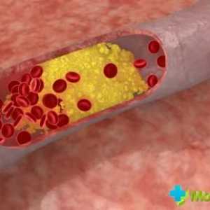 Jak si vybrat lék na snižování cholesterolu: vše, co potřebujete vědět o tom