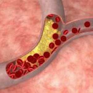 Jak léčit aterosklerózu a je to možné?