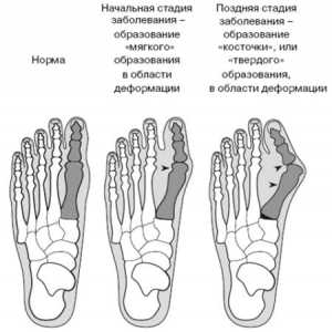 Jak vyléčit kost na noze: hladká a zdravá noha