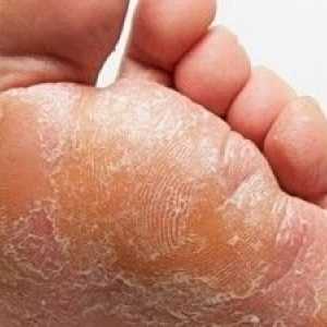 Jaké jsou mast houby na nohou? Tipy pro domácí léčbu.