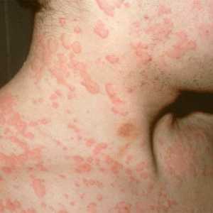 Co paraziti mohou způsobovat alergie u lidí