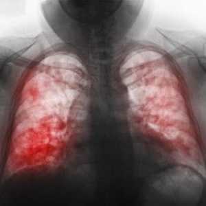 Jaké jsou příznaky zápalu plic u dětí? Diagnostika onemocnění.