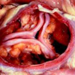 Kalcifikace aortální chlopně