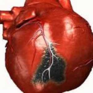 Kardiogenní šok