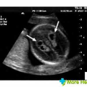 Cysta vaskulární plexus plodu na ultrazvuku