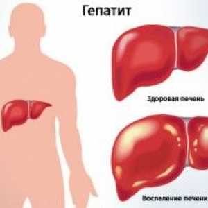 Hepatitida Clinic na: akutních a chronických forem