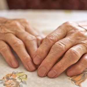 Léčbě artritidy rukou kloubů