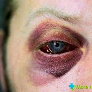 Léčba hematom očí až po provedené kontrole