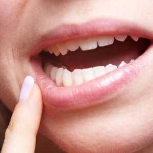 Léčba oparu v ústech