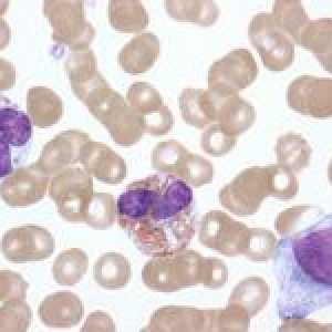 Leukemoid krevní reakce
