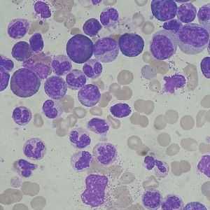 Leukocyty v moči - co to znamená? Příčiny bílých krvinek v moči.