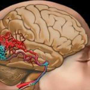 Malformace mozkových cév