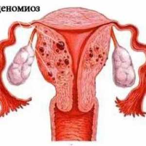 Menstruace s adenomyosy
