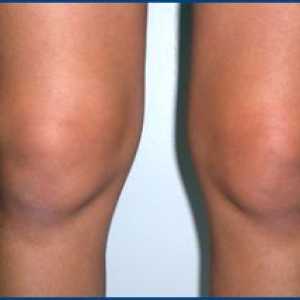 Metody léčby synovitidy kolena. Příznaky tohoto onemocnění.