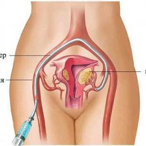 Děložní fibroidy (fibroidy) bez operace ve skutečnosti působí