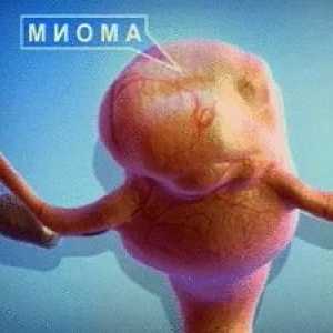 Děložní myomy - mazaný nepřítel žen