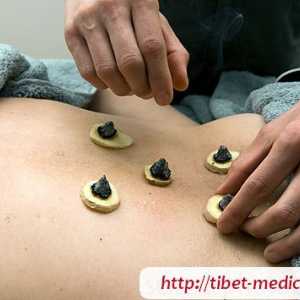Moksoterapiya - oteplování akupunkturních bodů
