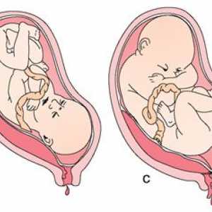 Low placenta previa