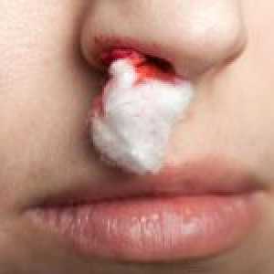 Krvácení z nosu v těhotenství