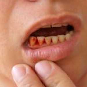 Co se krvácení z dásní