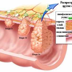 Co je prvním příznakem rakoviny tlustého střeva?