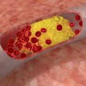Přehled léků, které snižují hladinu cholesterolu v krvi