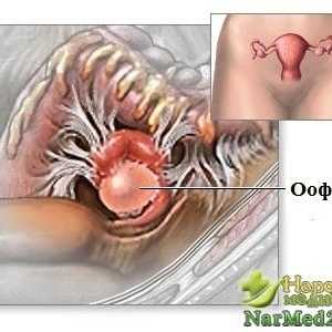Oophoritis - vážnou hrozbou pro zdraví žen
