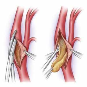 Chirurgické odstranění plaky cholesterolu při ateroskleróze (karotické endarterektomii)