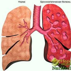 Popis bronchiektázie a její léčba lidových prostředků