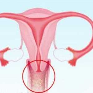 5 Hlavní příčiny kvasinkovou infekci u žen