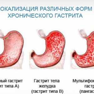 Rysy antrální gastritidu a způsoby léčení