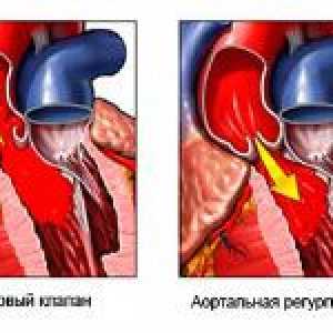 Rysy aortální nedostatečnost a její stupeň