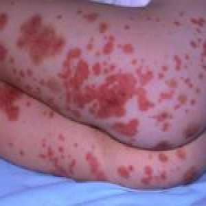 Rysy hemoragické vaskulitid u dětí