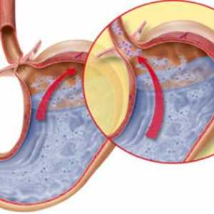 Vlastnosti a léčba refluxní gastritidy