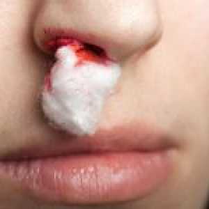 Příčiny krvácení z nosu, první pomoci a prevence