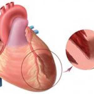 Nabízí transmurální infarkt myokardu a jeho léčba