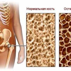 Osteoporóza - hlavní příčinou zlomenin
