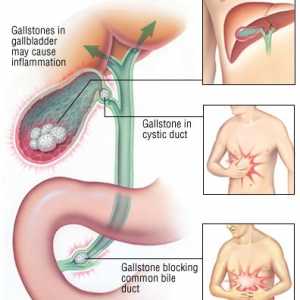 Akutní cholecystitida - infekce žlučových cest