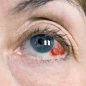 Proč prasknout cévy v očích: hlavní důvody
