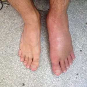 Otoky po zranění nohy