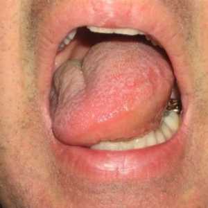 Otok úst, jazyka a krku